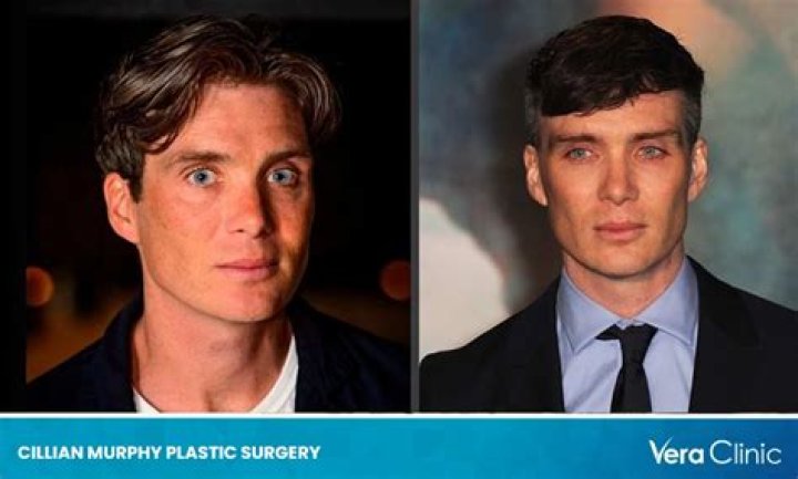 Cillian Murphy Nose | Did He Underwent Surgery | Before And After Pics