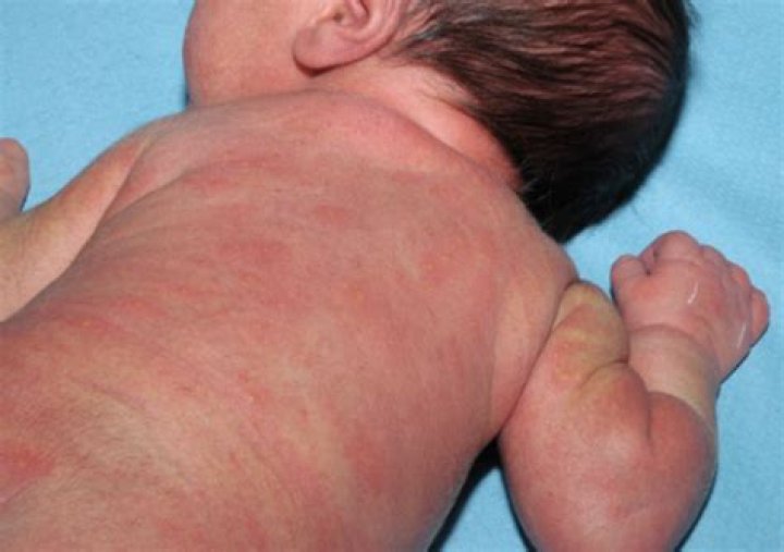 Erytheme Toxique Bébé