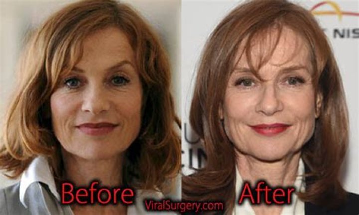 Isabelle Huppert Chirurgie Esthétique