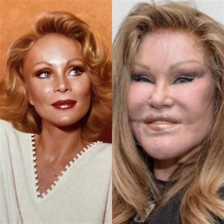 Jocelyn Wildenstein Before And After Plastic Surgery Young Photos- Where Is She Now?