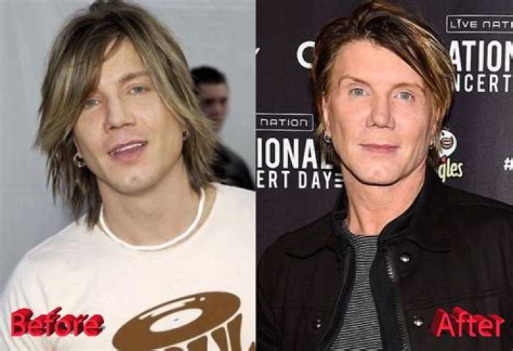 John Rzeznik Facelift | Goo Goo Dolls Frontman Plastic Surgery Before And After
