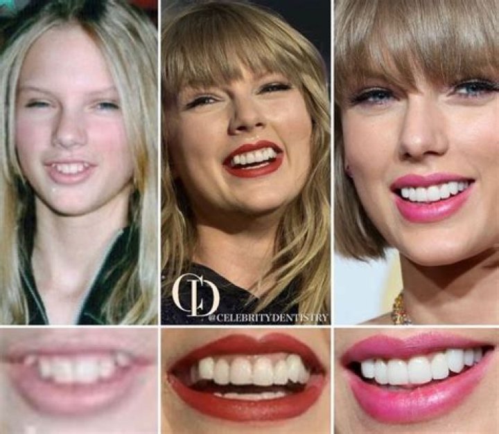Matty Healy’s Teeth: Taylor Swift Fans Mock Matt For Having Crooked Teeth!