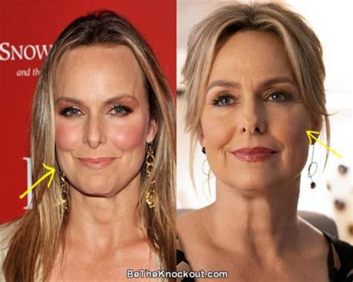 Melora Hardin Plastic Surgery Before and After