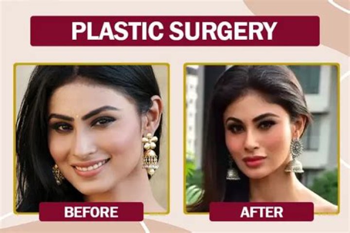Photos: Mouni Roy Before Plastic Surgery – How Much Face Surgery Did She Had?