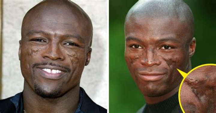 What Happened To Seal’s Face? Details On His Illness And Facial Scars